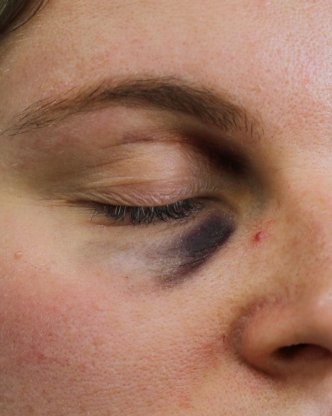 Musta silmä B - traumatatuoinnit