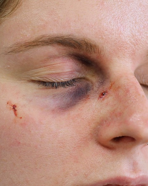 Musta silmä A - traumatatuoinnit