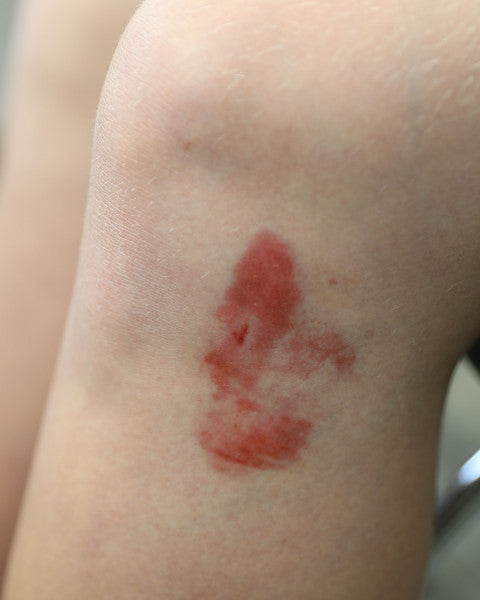 Mustelmat 1A - traumatatuoinnit