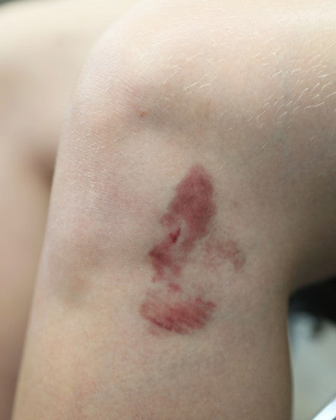 Mustelmat 1B - traumatatuoinnit