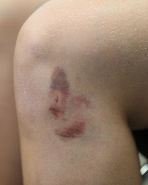 Mustelmat 1C - traumatatuoinnit