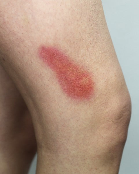 Mustelmat 2A - traumatatuoinnit