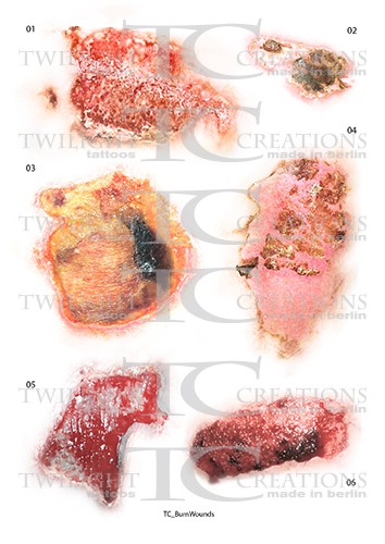 Palovammat - traumatatuoinnit