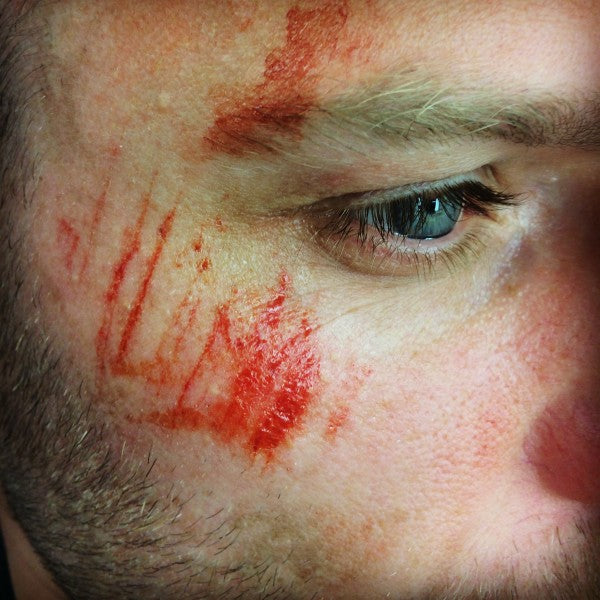 Naarmut 1 - traumatatuoinnit