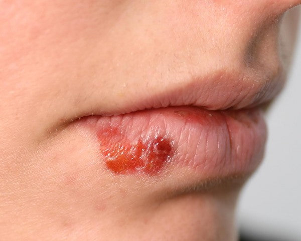 Ihosairaudet - traumatatuoinnit