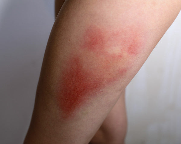 Mustelmat 3A - traumatatuoinnit