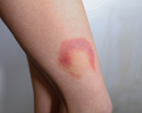 Mustelmat 3B - traumatatuoinnit