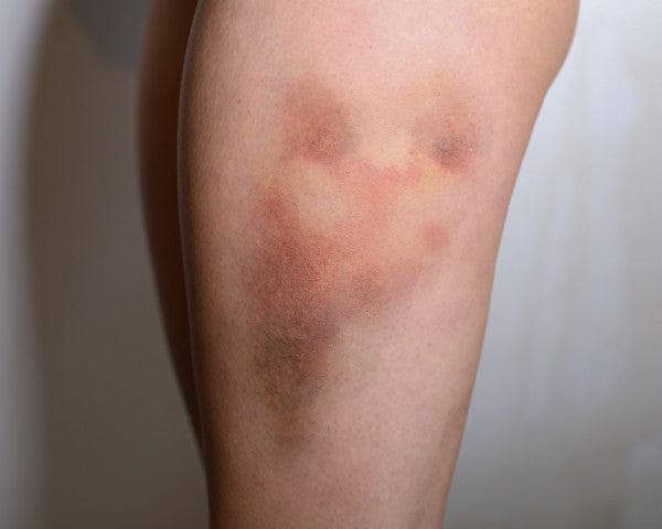 Mustelmat 3C - traumatatuoinnit