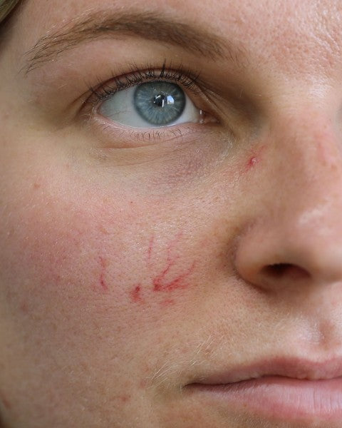 Verisuonet - traumatatuoinnit