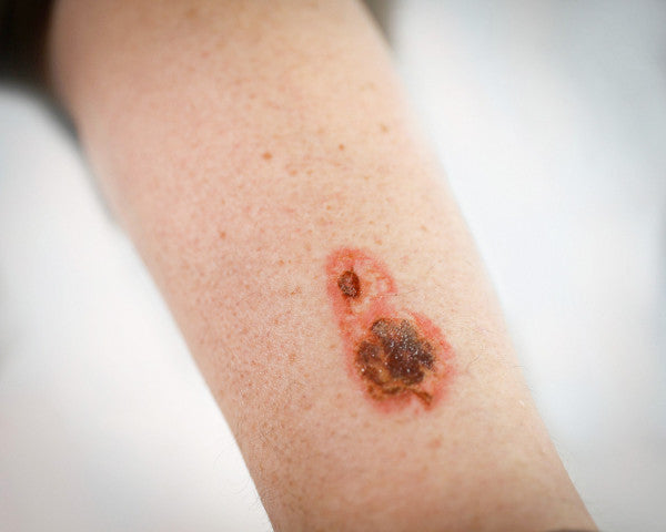 Burn wounds - Tattoo Transfer  